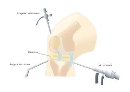 ARTHROSCOPY